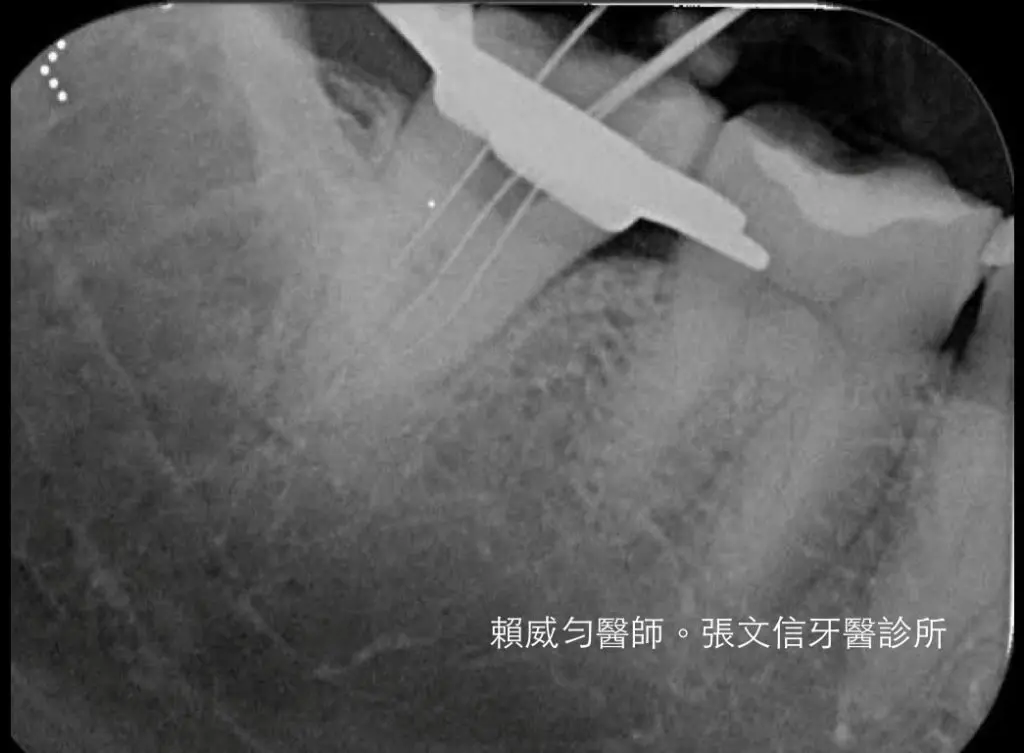 賴威勻醫師 醫學中心顯微根管指導醫師 C-形根管案例分享 3 2327066-orig_orig