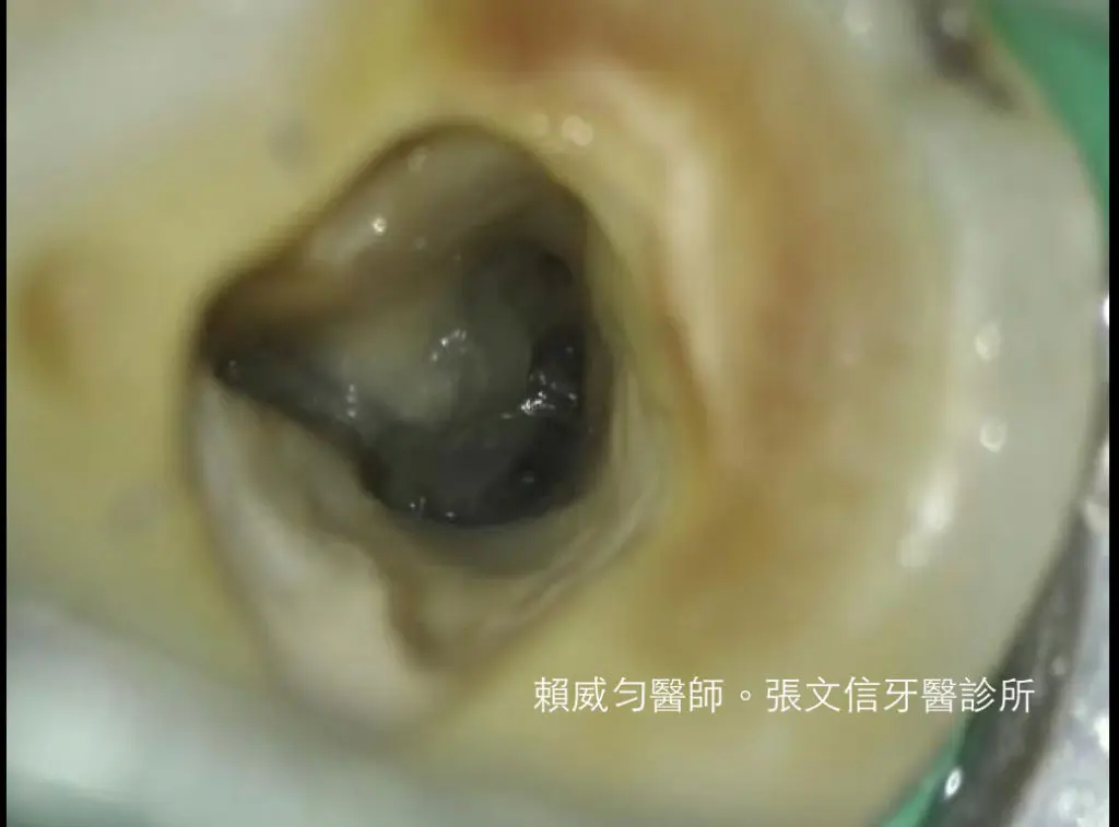 賴威勻醫師 醫學中心顯微根管指導醫師 C-形根管案例分享 2 4363375-orig_orig