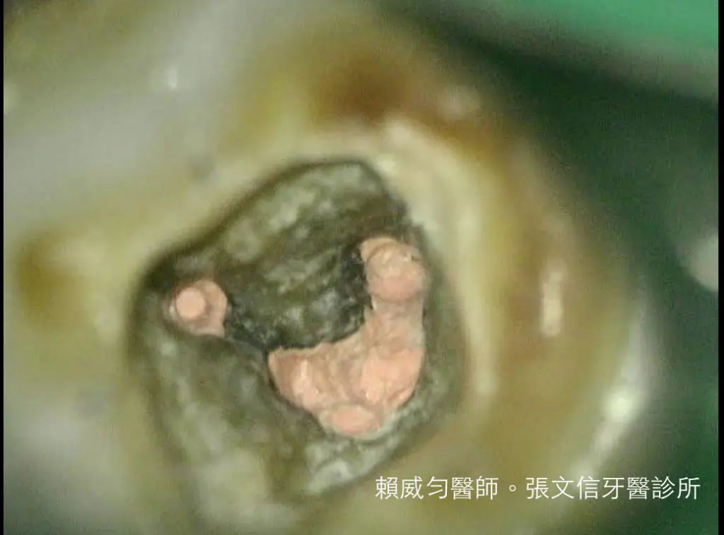 賴威勻醫師 醫學中心顯微根管指導醫師 C-形根管案例分享 4 5134702-orig_orig