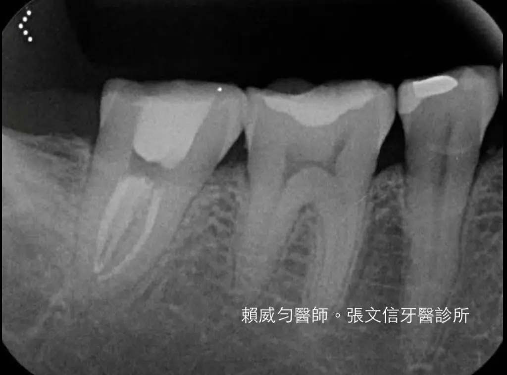 賴威勻醫師 醫學中心顯微根管指導醫師 C-形根管案例分享 5 548192-orig_orig