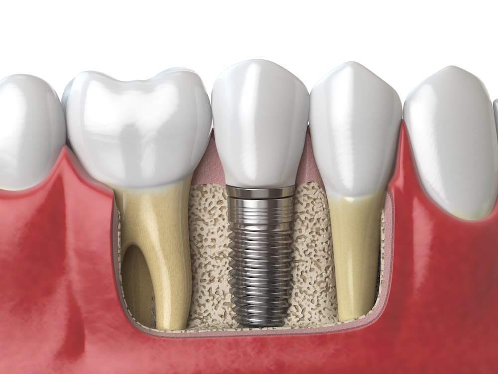 植牙跟牙橋怎麼選好困擾，讓專業牙科醫師來說明