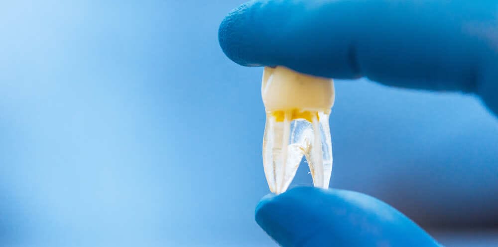Read more about the article 牙齒神經壞死牙齒變黑只能根管治療嗎？