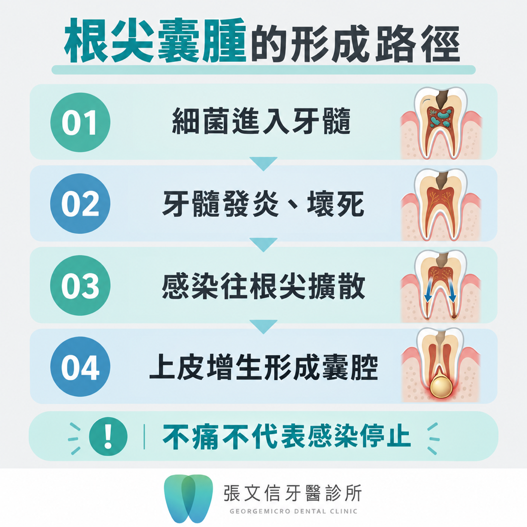 以四個步驟說明細菌進入牙髓、牙髓壞死及感染形成根尖囊腫的過程